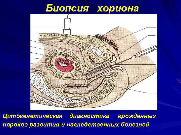 Биопсия хориона Цитогенетическая диагностика врожденных пороков развития и наследственных болезней 