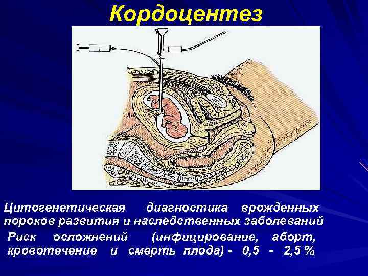 Кордоцентез Цитогенетическая диагностика врожденных пороков развития и наследственных заболеваний Риск осложнений (инфицирование, аборт, кровотечение