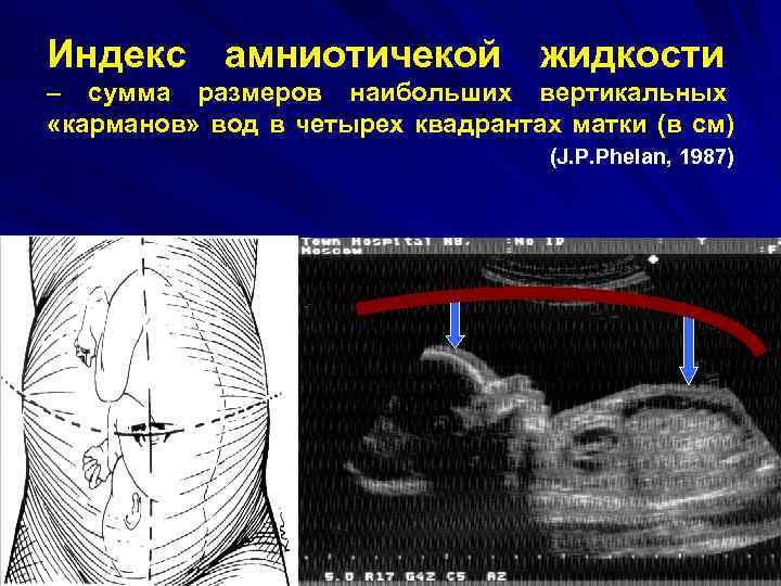 Индекс амниотичекой жидкости – сумма размеров наибольших вертикальных «карманов» вод в четырех квадрантах матки