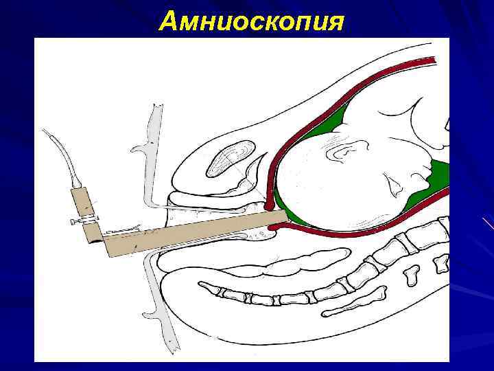 Амниоскопия 