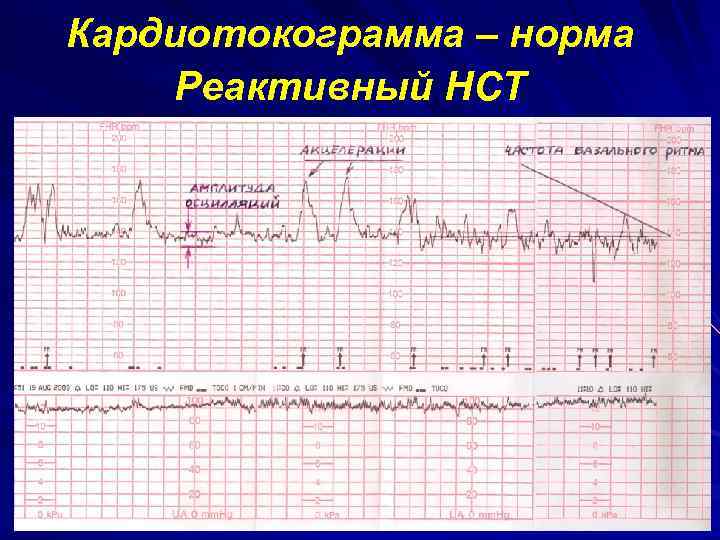 Кардиотокограмма – норма Реактивный НСТ 