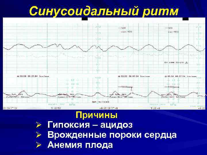 Синусоидальный ритм Ø Ø Ø Причины Гипоксия – ацидоз Врожденные пороки сердца Анемия плода