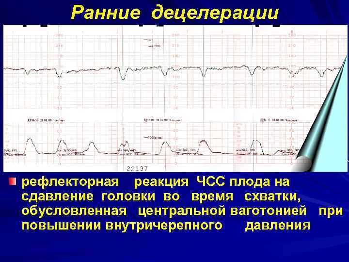 Ранние децелерации рефлекторная реакция ЧСС плода на сдавление головки во время схватки, обусловленная центральной