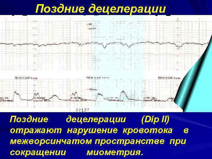 Поздние децелерации (Dip II) отражают нарушение кровотока в межворсинчатом пространстве при сокращении миометрия. 