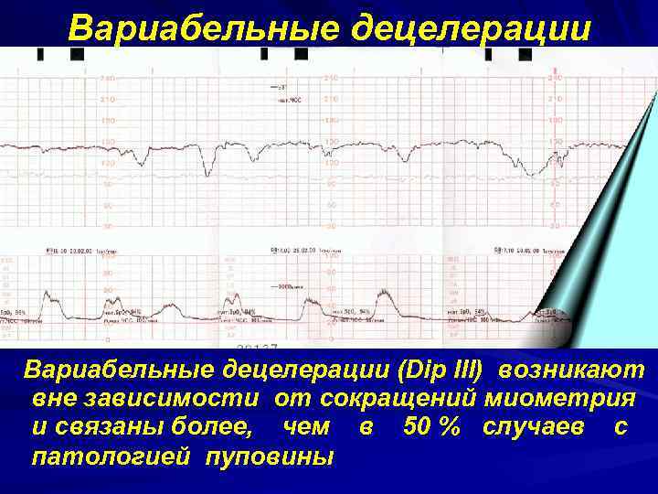 Вариабельные децелерации (Dip III) возникают вне зависимости от сокращений миометрия и связаны более, чем