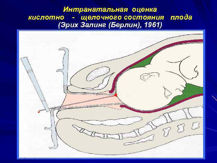 Интранатальная оценка кислотно - щелочного состояния плода (Эрих Залинг (Берлин), 1961) 