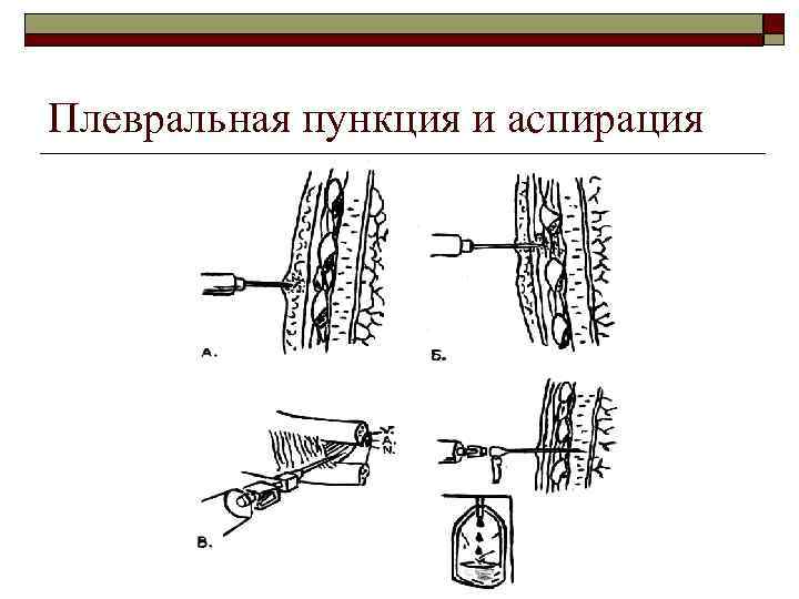 Плевральная пункция и аспирация 