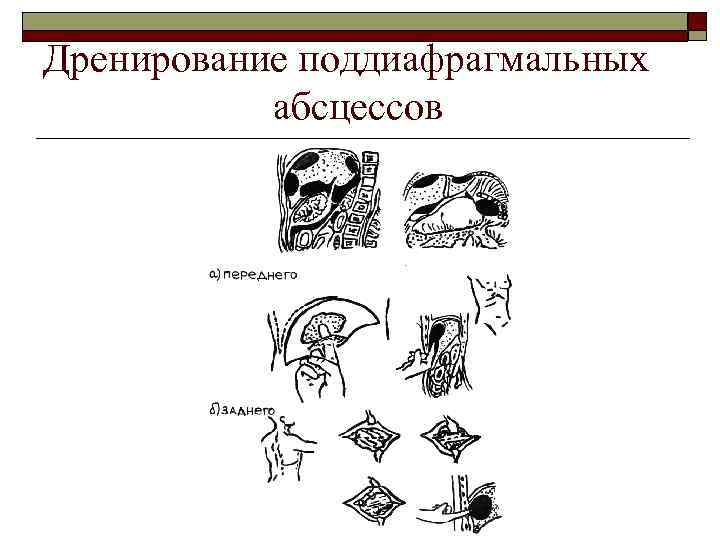 Дренирование поддиафрагмальных абсцессов 