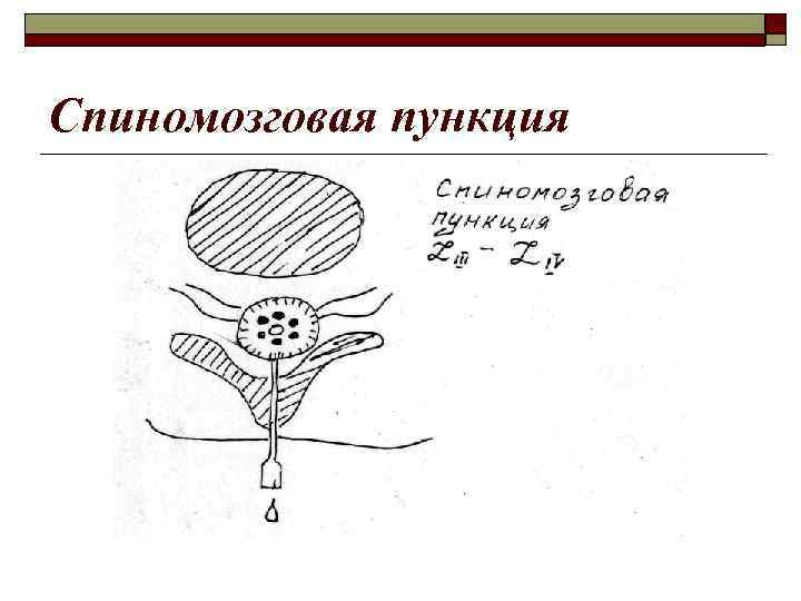 Спиномозговая пункция 