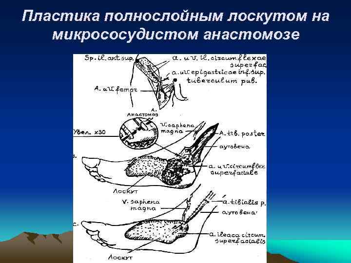 Лоскуты на микрососудистом анастомозе применяемые в челюстно лицевой хирургии презентация