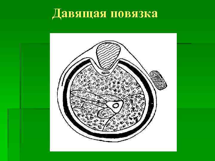 Давящая повязка 