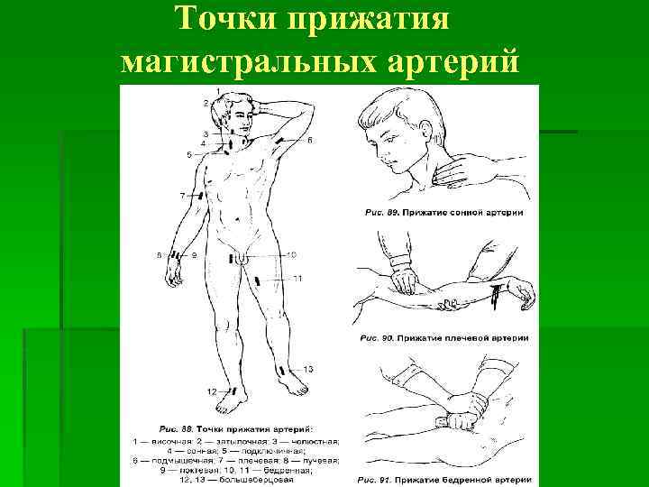 Пальцевое прижатие при повреждении бедренной артерии. Точки пальцевого прижатия артерий. Пальцевое прижатие магистральных артерий. Точки прижатия артерий при кровотечении. Прижатие бедренной артерии.