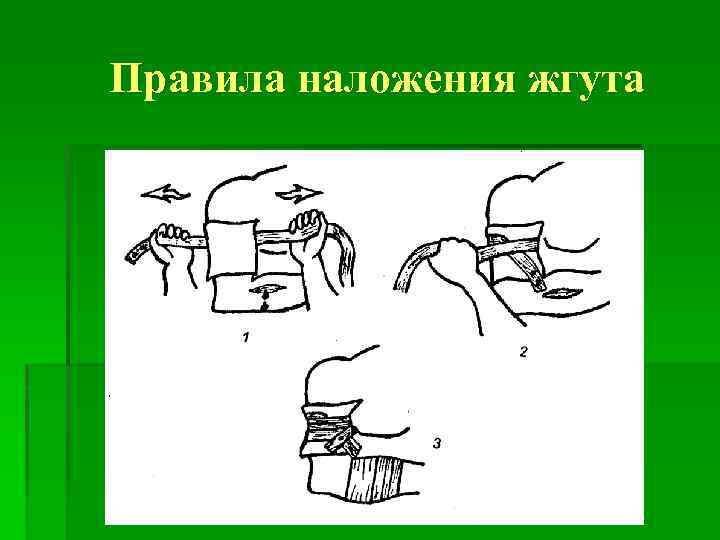 Правила наложения жгута 
