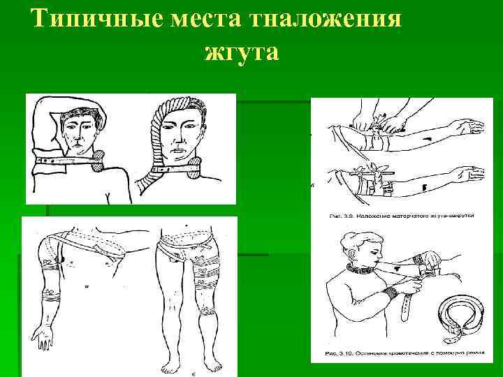 Типичные места тналожения жгута 
