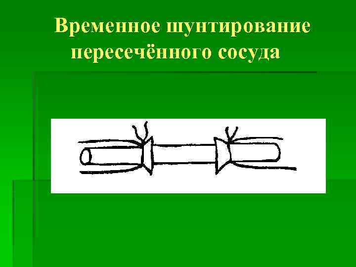 Временное шунтирование пересечённого сосуда 