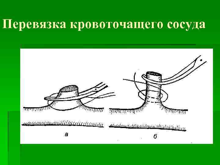 Перевязка в ране и на протяжении