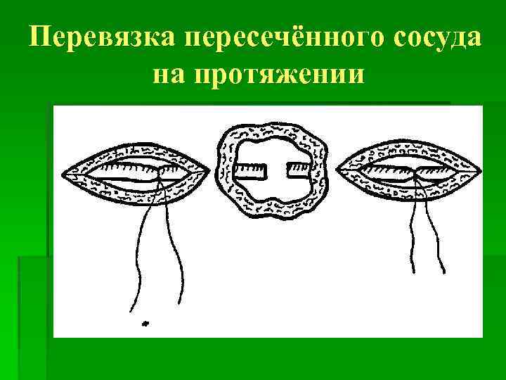 Перевязка в ране и на протяжении. Перевязка сосуда на протяжении. Перевязка артерии на протяжении. Прошивание (перевязка) сосуда на протяжении. Перевязка кровеносного сосуда на протяжении.