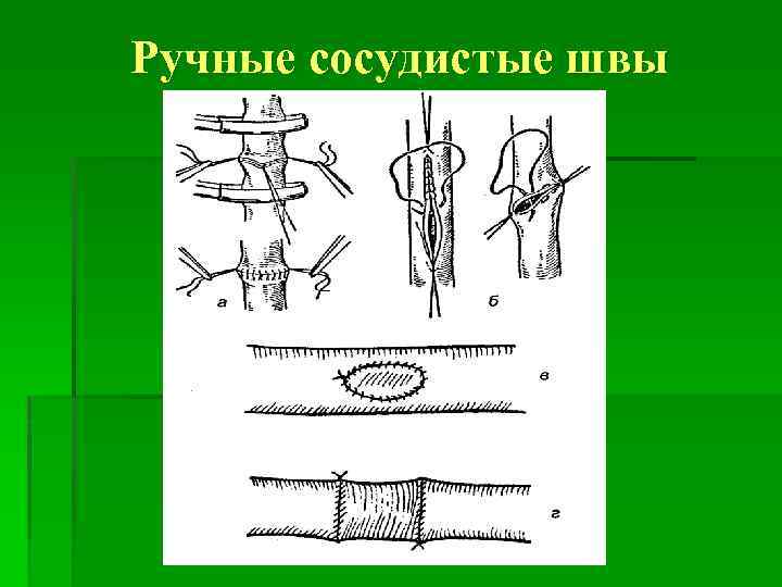 Сосудистый шов методы наложения. Хирургия механический шов.