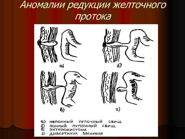 Аномалии редукции желточного протока 