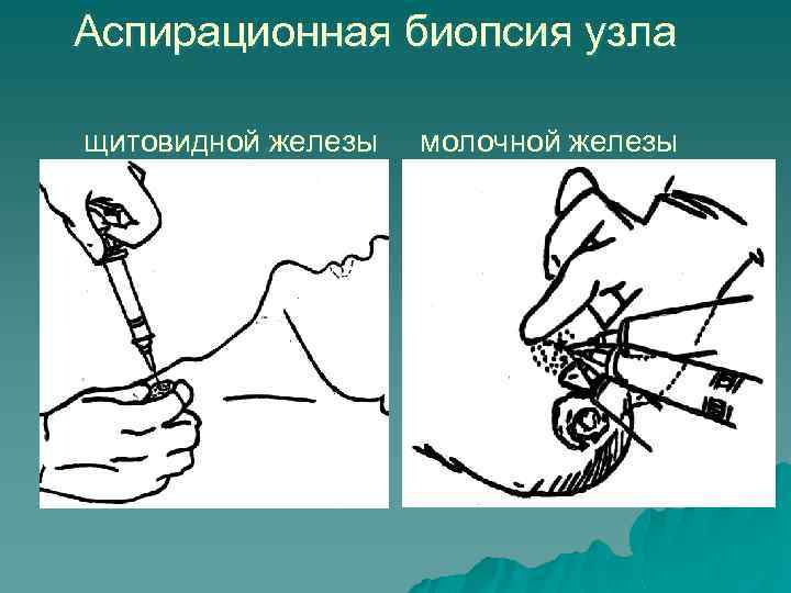 Аспирационная биопсия узла щитовидной железы молочной железы 