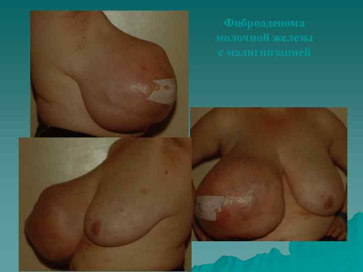 Фиброаденома молочной железы с малигнизацией 
