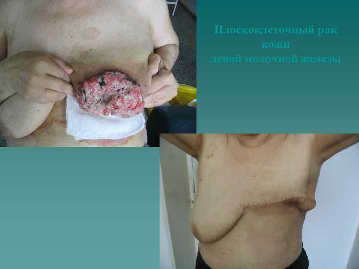 Плоскоклеточный рак кожи левой молочной железы 