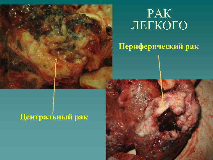РАК ЛЕГКОГО Периферический рак Центральный рак 