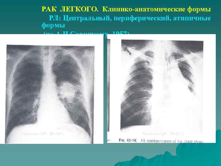 РАК ЛЕГКОГО. Клинико-анатомические формы РЛ: Центральный, периферический, атипичные формы (по А. И. Савицкому, 1957)