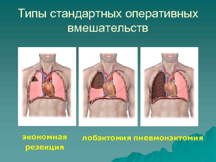 Типы стандартных оперативных вмешательств экономная резекция лобэктомия пневмонэктомия 