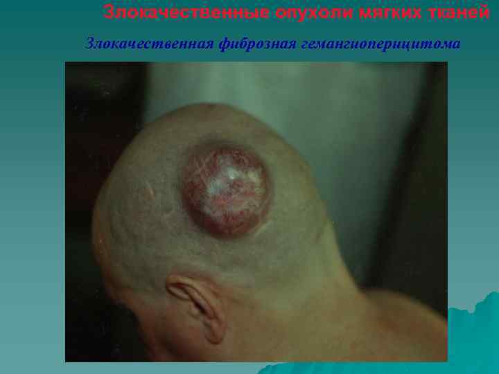 Злокачественные опухоли мягких тканей Злокачественная фиброзная гемангиоперицитома 