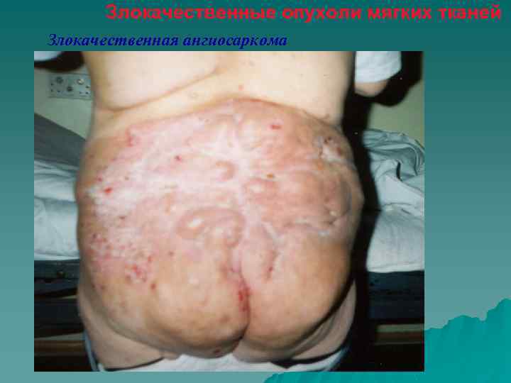 Злокачественные опухоли мягких тканей Злокачественная ангиосаркома 