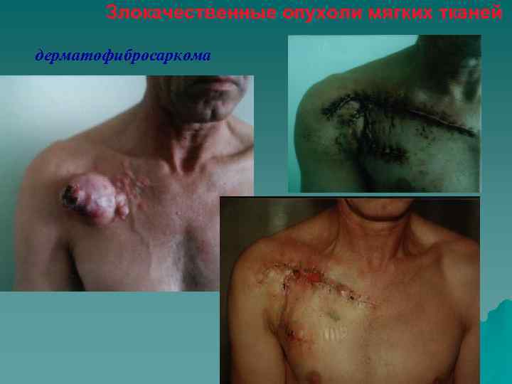 Злокачественные опухоли мягких тканей дерматофибросаркома 