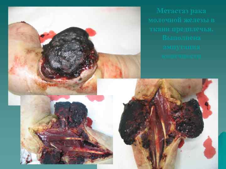 Метастаз рака молочной железы в ткани предплечья. Выполнена ампутация конечности 
