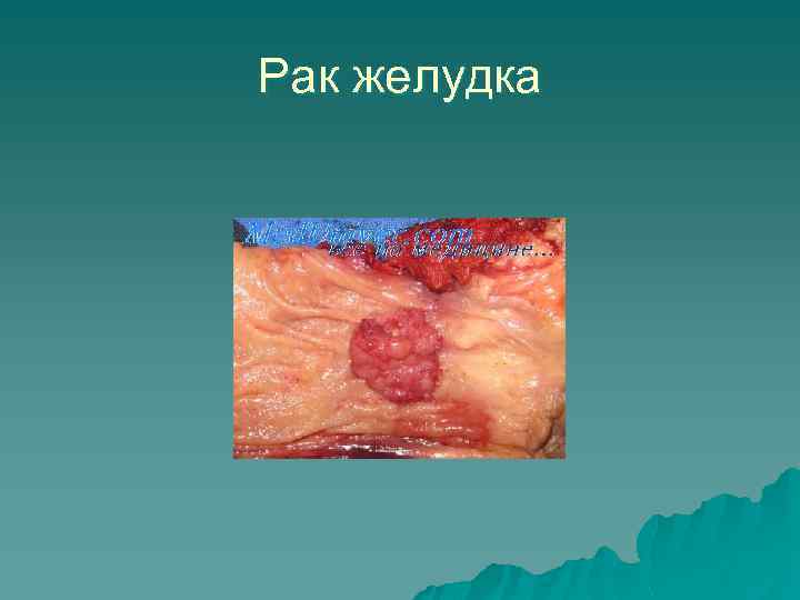 Рак желудка 