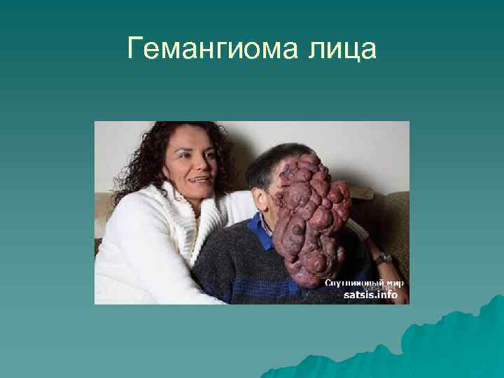 Гемангиома лица 