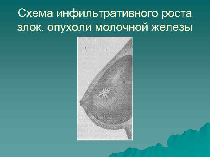 Схема инфильтративного роста злок. опухоли молочной железы 