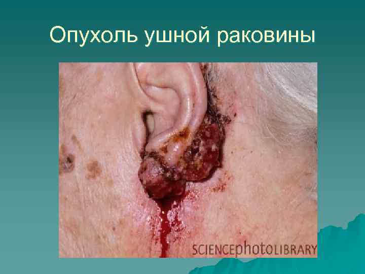 Опухоль ушной раковины 
