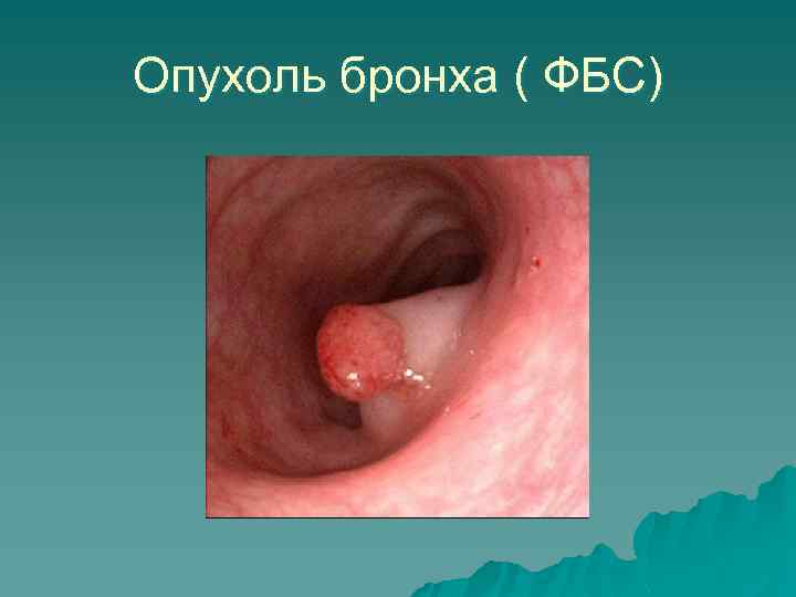 Опухоль бронха ( ФБС) 