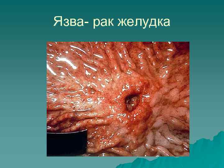 Язва- рак желудка 