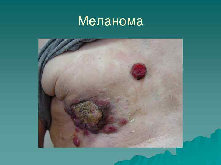 Меланома 