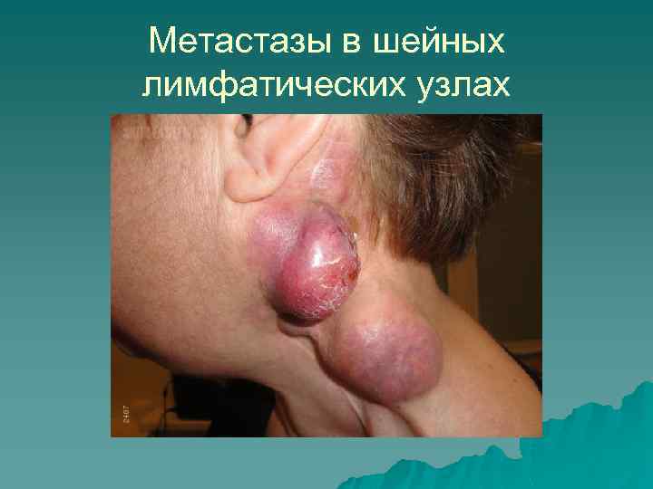 Метастазы в шейных лимфатических узлах 