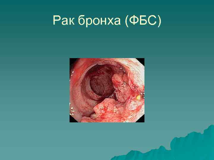 Рак бронха (ФБС) 
