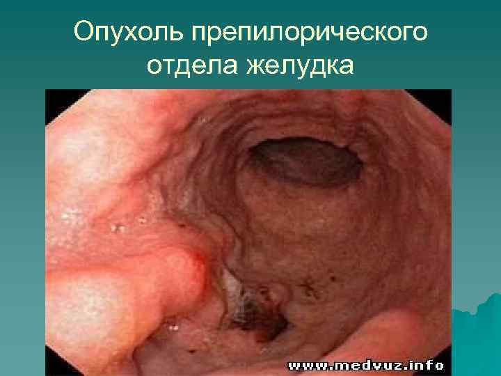 Опухоль препилорического отдела желудка 