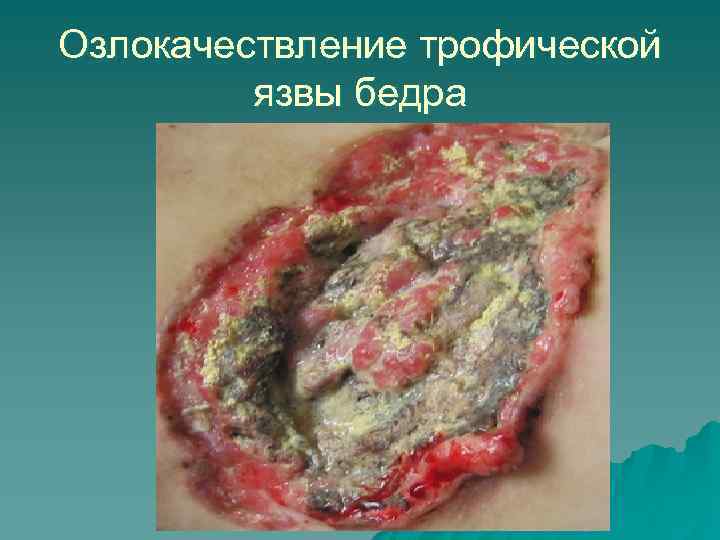 Озлокачествление трофической язвы бедра 