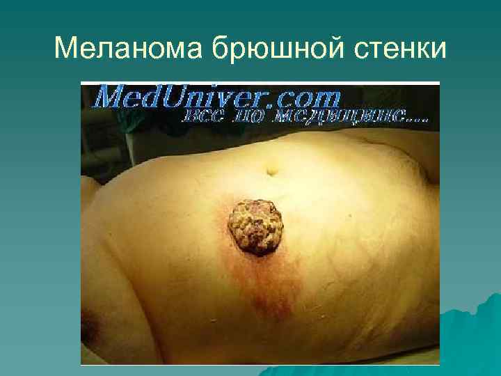 Меланома брюшной стенки 