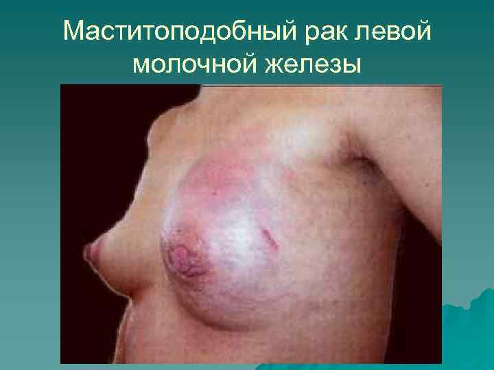 Маститоподобный рак левой молочной железы 