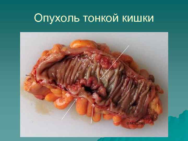 Опухоль тонкой кишки 
