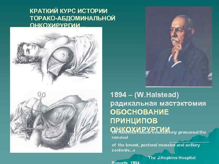 КРАТКИЙ КУРС ИСТОРИИ ТОРАКО-АБДОМИНАЛЬНОЙ ОНКОХИРУРГИИ… 1894 – (W. Halstead) радикальная мастэктомия ОБОСНОВАНИЕ ПРИНЦИПОВ ОНКОХИРУРГИИ