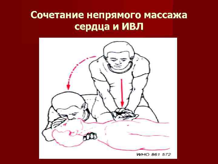Сочетание непрямого массажа сердца и ИВЛ 