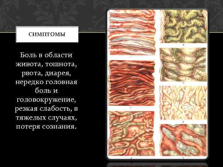 СИМПТОМЫ Боль в области живота, тошнота, рвота, диарея, нередко головная боль и головокружение, резкая